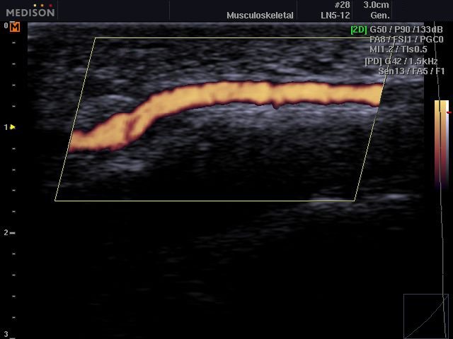 Blood flow in the soft tissues of the wrist, power doppler (echogramm №530)