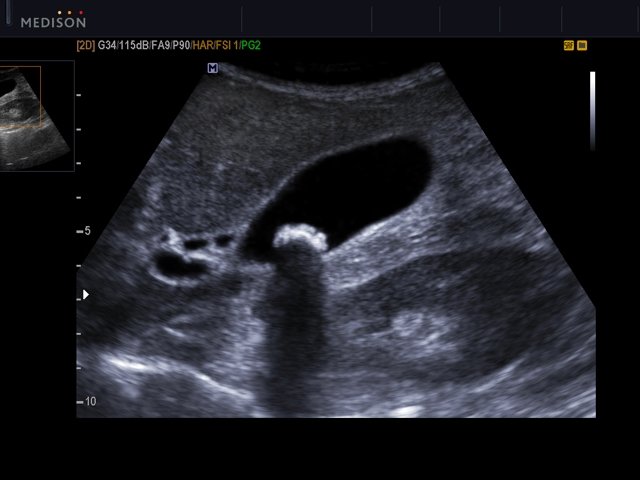 Gallbladder stone, B-mode (echogramm №531)