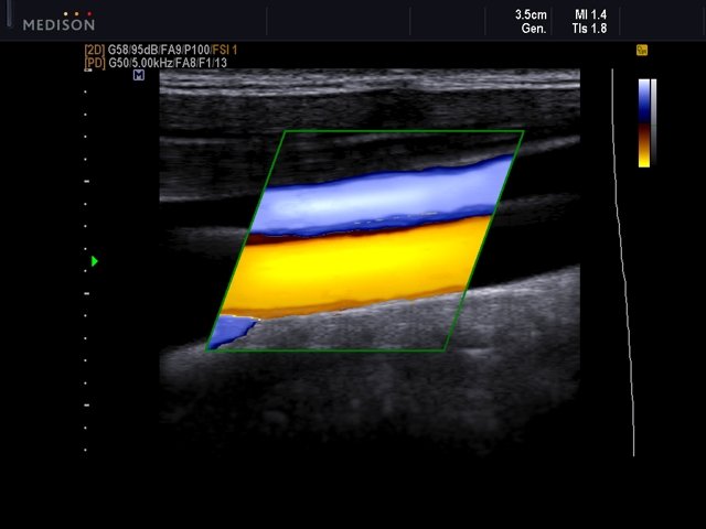 Common carotid artery and jugular vein, DPDI (echogramm №532)