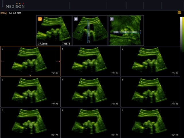 Gallbladder stones, MSV & 3D (echogramm №536)