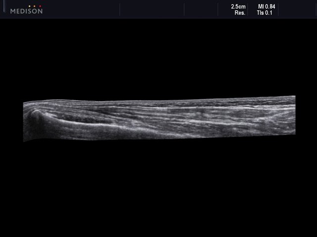 Soft tissue limb, panoramic view (echogramm №537)