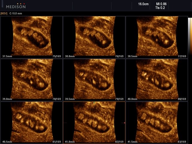 Multiple gallbladder stones, MSV & 3D (echogramm №539)