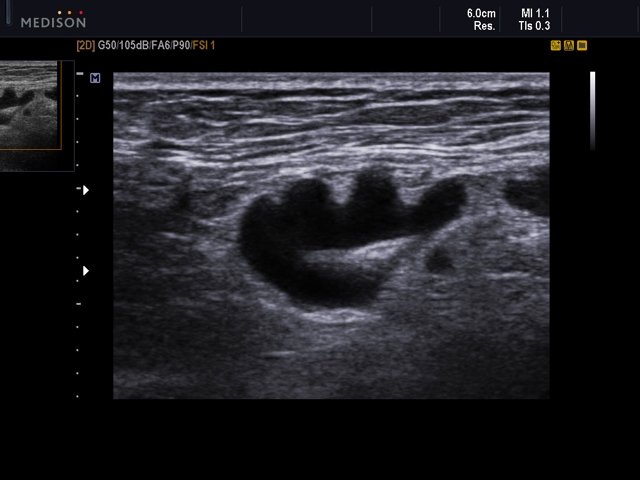 Neck side lymphadenitis, B-mode (echogramm №540)