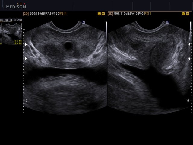 Prostatic utricle cyst, B-mode (echogramm №541)