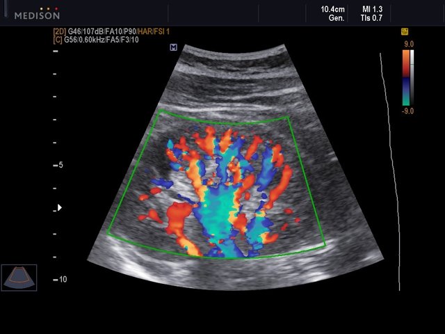 Right kidney, color doppler (echogramm №542)