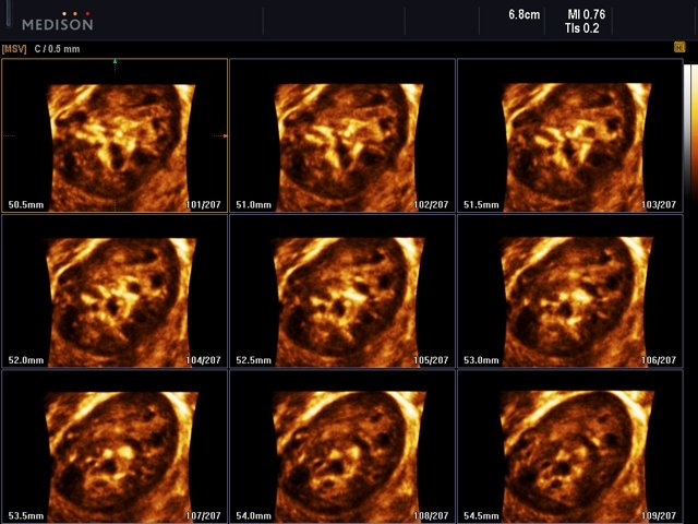 Right kidney, MSV & 3D (echogramm №543)