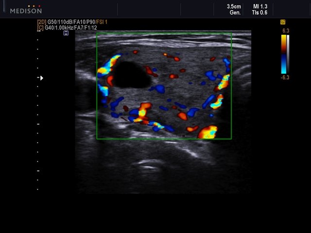 Thyroid - colloid nodes, color doppler (echogramm №544)