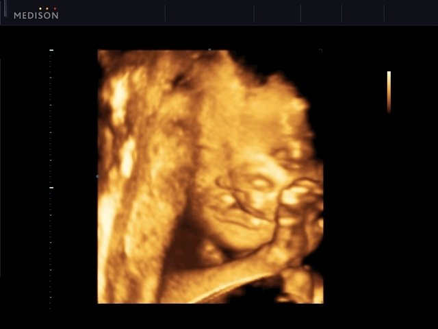Cleft palate - defect of fetal`s development, 3D (echogramm №546)