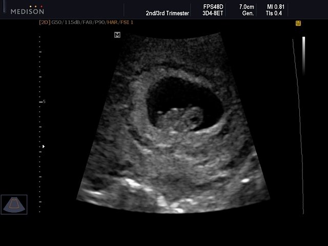Fetus - 8 weeks, B-mode (echogramm №547)