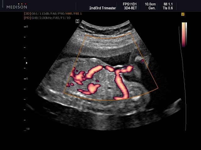 Fetal blood circulation, power doppler (echogramm №548)