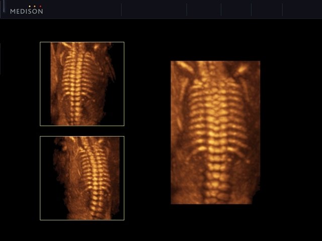 Fetal spine, 3D (echogramm №549)