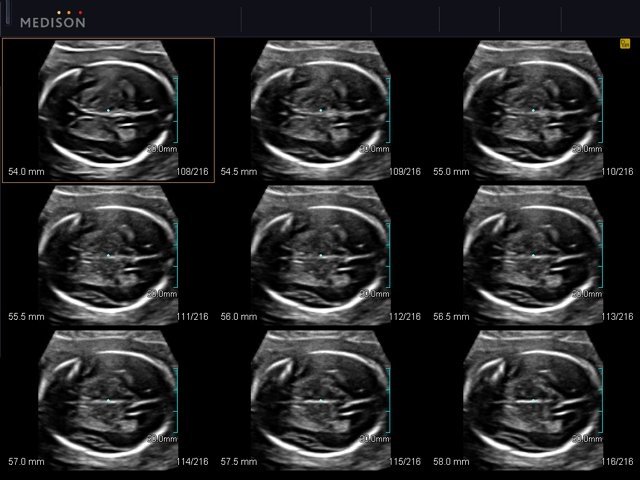 Fetal brain, MSV (echogramm №550)