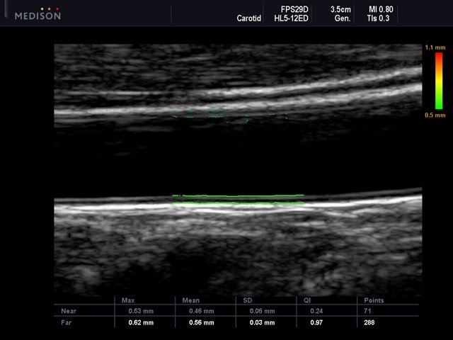 Common carotid artery, Auto IMT (echogramm №551)