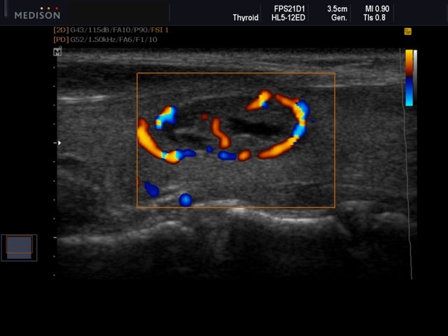 Thyroid nodule, DPDI (echogramm №553)