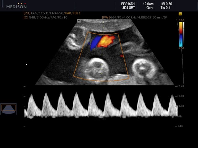 Umbilical vessels, CFM & PW (echogramm №554)