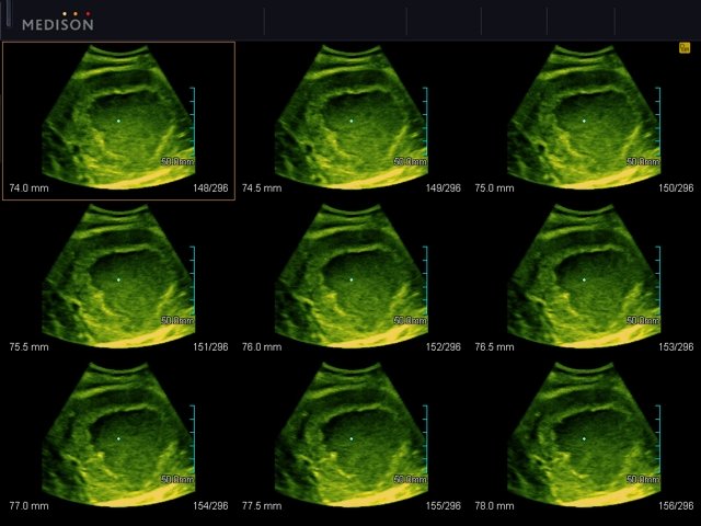 Liver tumor, MSV (echogramm №555)