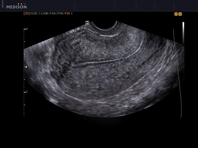 Uterus, B-mode (echogramm №558)
