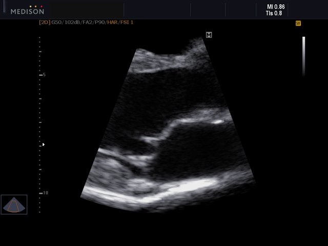 Heart (long axis of LV), B-mode (echogramm №560)