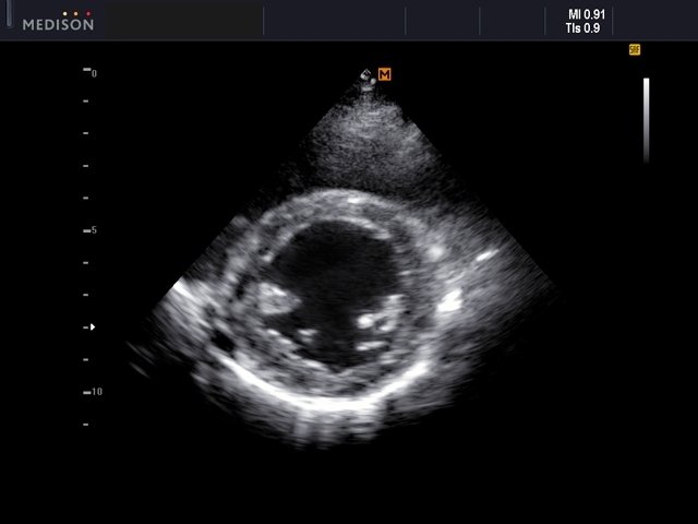 Heart (short axis of LV), B-mode (echogramm №561)