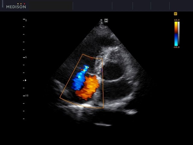 Mitral valve - regurgitation, color doppler (echogramm №562)