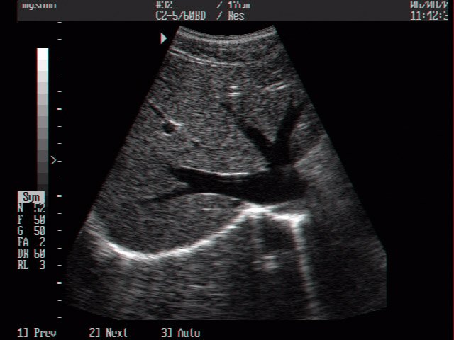 Liver, B-mode (echogramm №6)
