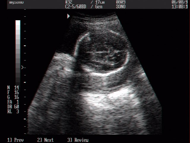 Fetal head, B-mode (echogramm №9)