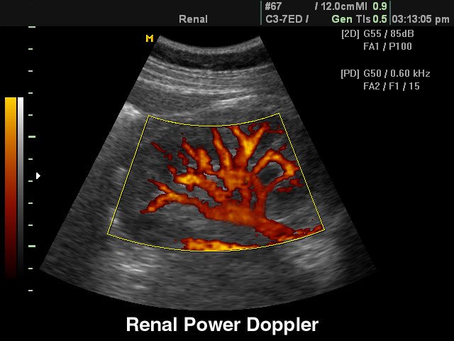 Kidney, power doppler (echogramm №98)