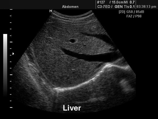 Liver, B-mode (echogramm №99)
