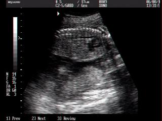 Fetal heart, B-mode