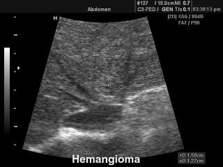 Liver hemangioma, B-mode