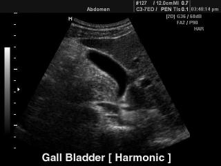 Gall bladder - tissue harmonic, B-mode