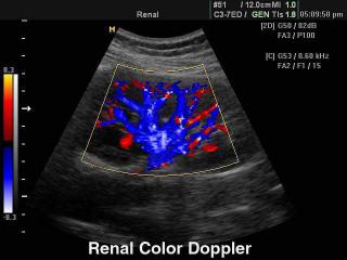 Kidney, color doppler