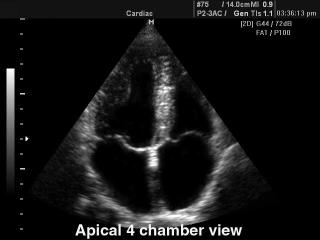Heart (4 chamber view), B-mode