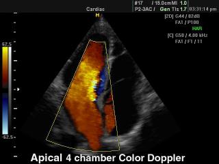 Heart (4 chamber view), color doppler