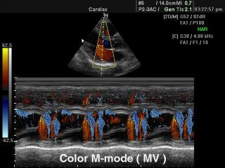 Mitral valve, color M-mode