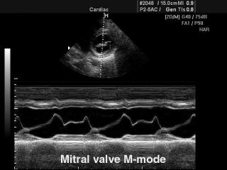 Mitral valve, M-mode