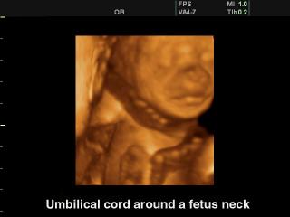 Umbilitical cord around a fetus neck, 3D