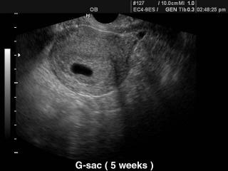 Gestational sac - 5 weeks, B-mode