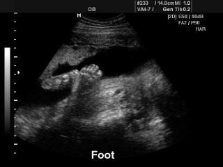 Fetal foot, B-mode