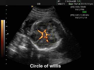 Circle of Willis, power doppler