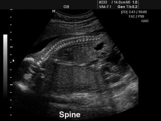 Fetal spine, B-mode