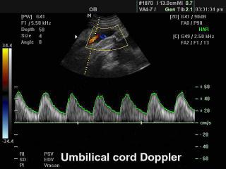 Umbilical cord, CFM & PW