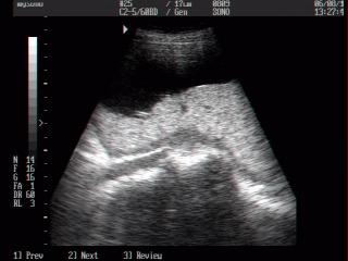 Placenta, B-mode