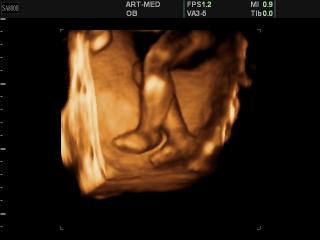 Fetal foots, 3D