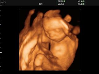 Fetus - 20 weeks, 3D