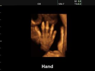 Fetal hand, 3D
