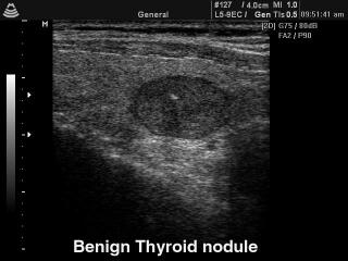 Thyroid benign nodule, B-mode