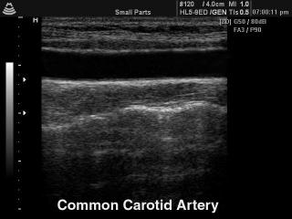 Common carotid artery, B-mode