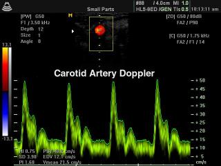 Common carotid artery, CFM & PW