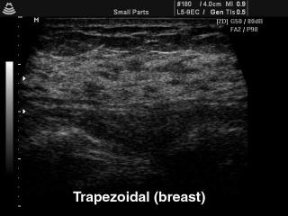 Breast, trapezoidal B-mode